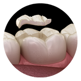 illustration of molar tooth with Sealant overlay above the tooth