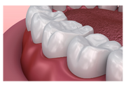 Illustration of teeth that have sealants on them